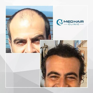 Image of Medhair Clinic Hair Transplant Gallery 3