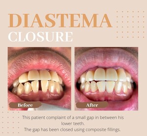 Image of Composite fillings