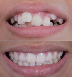 Image of Braces