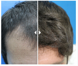 Image of Hair Transplantation Before and After