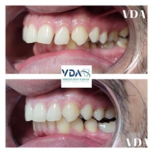 Image of Veneers Dent Albania Clinic Gallery 2