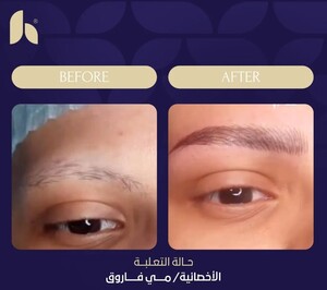 Image of Eyebrow transplant - Al Hokail Medical Center