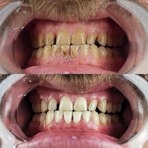 Image of Teeth Whitening - Selin Dental Clinic