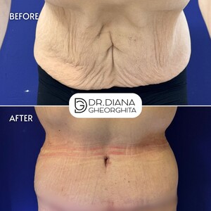 Image of Tummy tuck, Dr. Diana Gheorghita