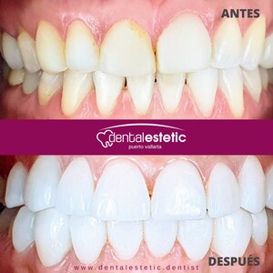 Image of Teeth whitening and dental crowns