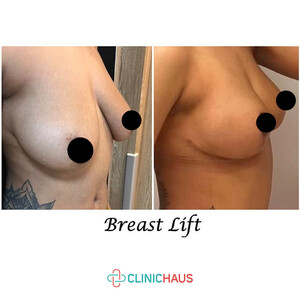 Image of Breast Lift