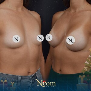 Image of Breast Implant - Neom Clinic