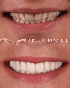 Image of E-max laminate veneers