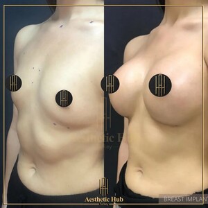 Image of Breast Implant - Aesthetic Hub Turkey