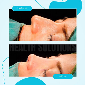 Image of Before and After Rhinoplasty Surgery - Sixth House Health Solutions