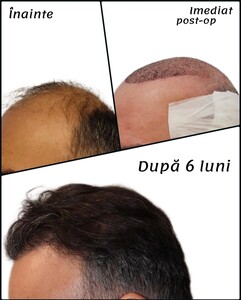 Image of Dr Felix Hair Implant Gallery 0