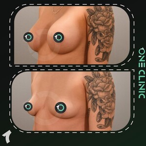 Image of Breast Implant - One Clinic