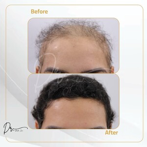 Image of Beauty Elements Clinics provides innovative solutions for hair loss treatments. 