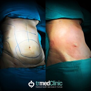 Image of Tummy tuck