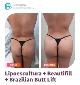 Image of Liposculpture and BBL