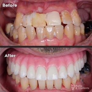 Image of All on 4 dental implants