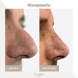 Image of Rhinoplasty