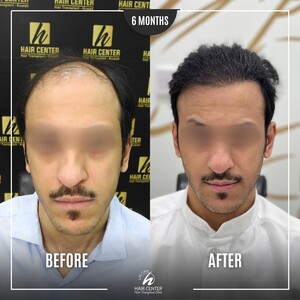 Image of Before and After a Hair Transplant