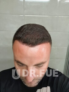 Image of Hair implant after - Dr. FUE