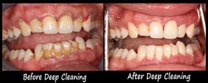 Image of Deep cleaning