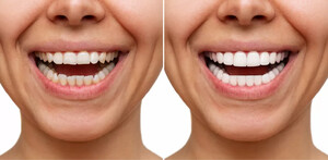 Image of Hollywood smile