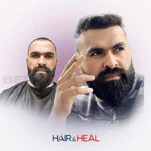 Image of Hair transplant results