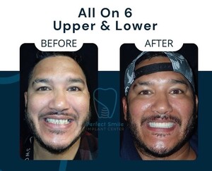 Image of All on 6 Upper and Lower Dental Implants