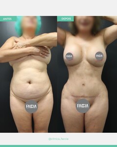 Image of Tummy tuck - Faccia