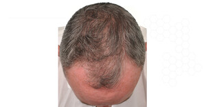 Image of More and More Hair Transplant Gallery 0