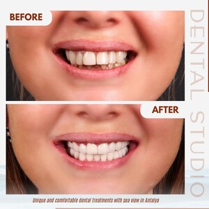 Image of Smile makeover before and after