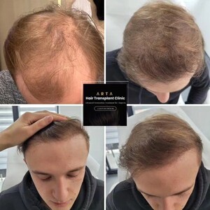 Image of Hair transplant - Arta Hair Clinic