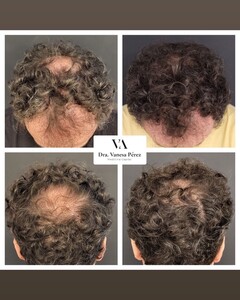 Image of Hair loss treatment