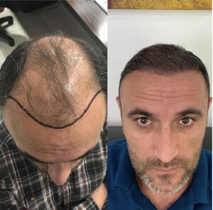 Image of Before and After Hair Transplantation