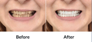 Image of Teeth whitening before and after