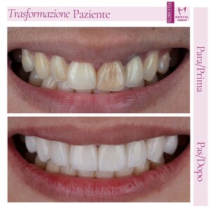 Image of Teeth whitening - Florentia Dent 