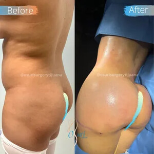 Image of Brazilian Butt Lift