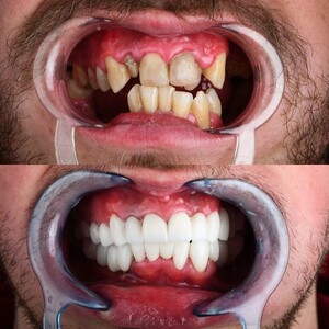 Image of Smile Makeover - Dr Colic Dental Clinic