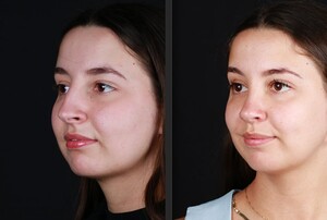 Image of 7 months after Rhinoplasty