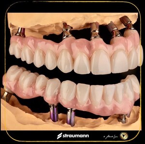 Image of Dental implants - Dr. Aleksandrs Lavrovs