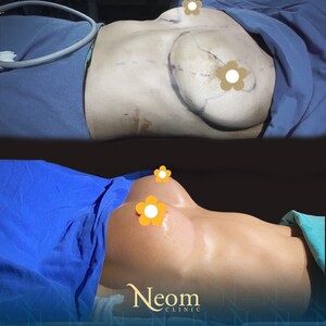 Image of Breast augmentation - Neom Clinic