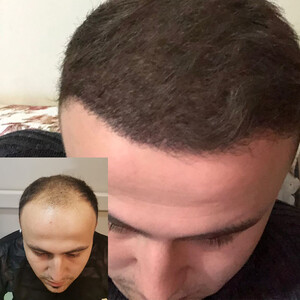 Image of Get DHI Hair Transplant Antalya Gallery 1