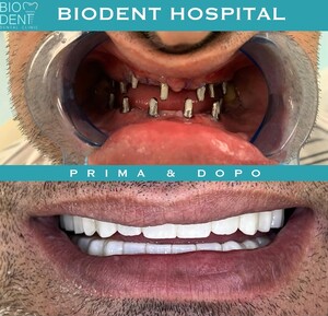 Image of Dental implants - Biodent