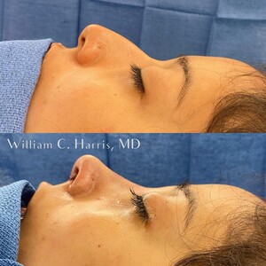 Image of Rhinoplasty