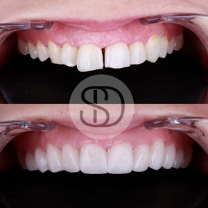 Image of Full Mouth Restoration with Zirconia