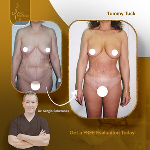 Image of Tummy tuck