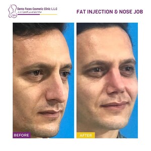 Image of Before and After Rhinoplasty