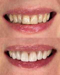 Image of Smile makeover - Apolodor Dental Clinic