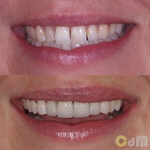 Image of Porcelain veneers 