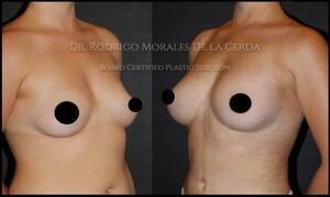 Image of Breast implants