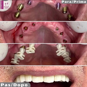 Image of Teeth implants - Florentia Dent 